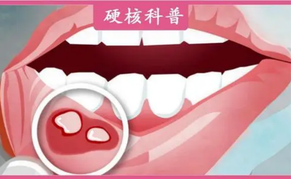 口腔疾病有哪些？如何预防和治疗？